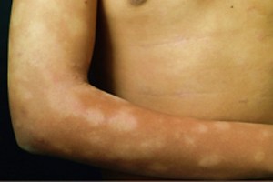 29-de-enero-de-2016%2c-dia-contra-la-lepra